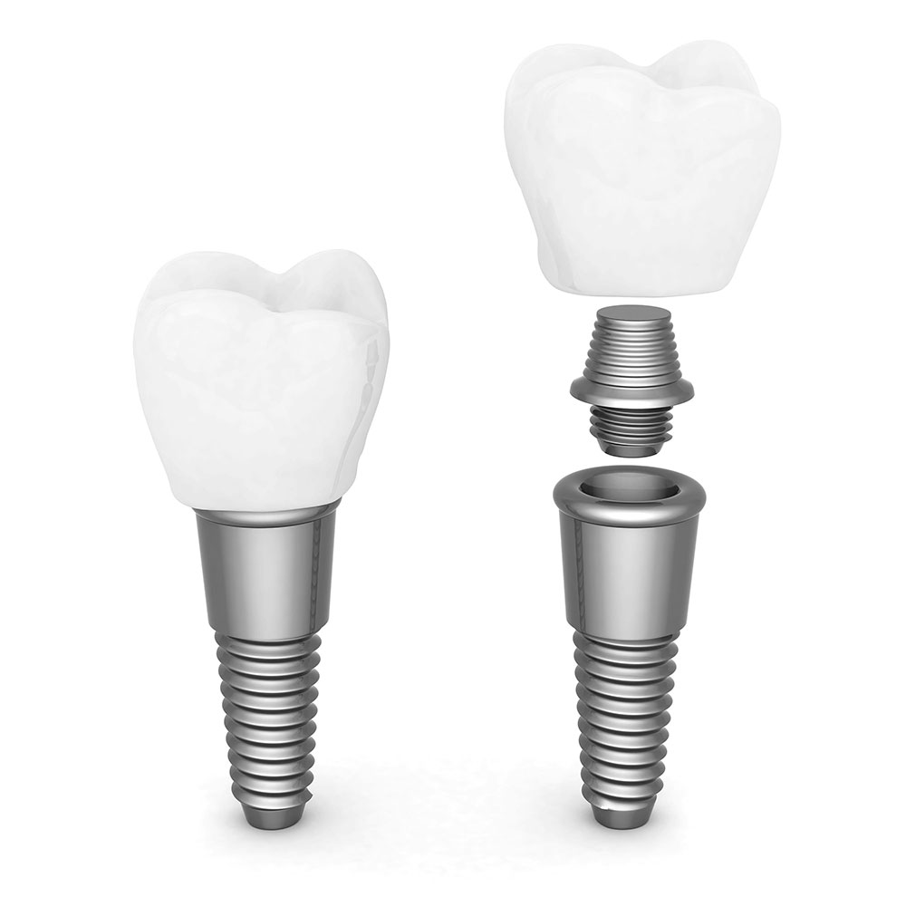 dental implants